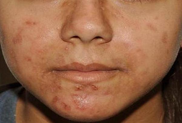 محرک های شایع بروز آکنه پوستی را بشناسیم